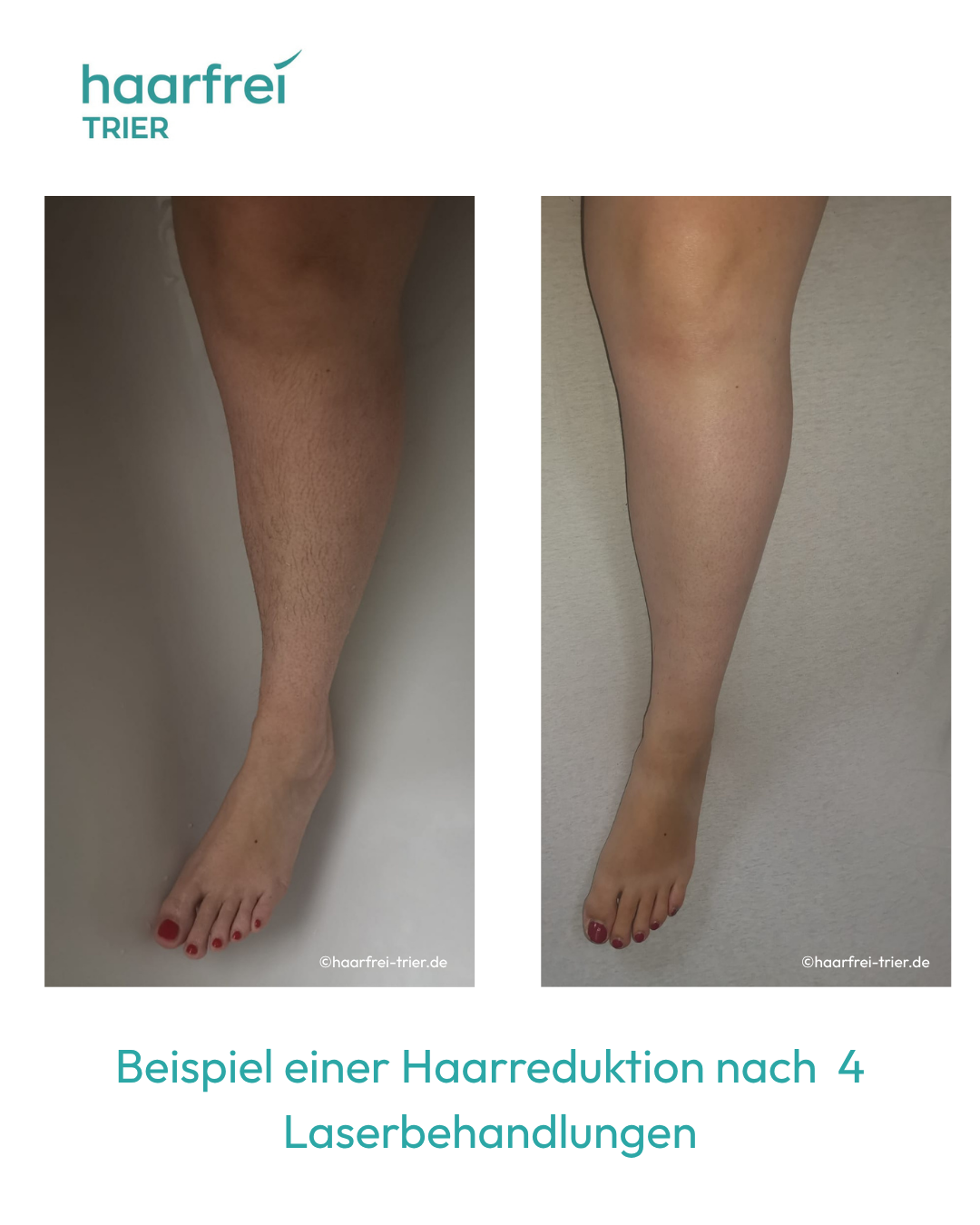 Laser Haarentfernung Beine Trier – nach 4 Behandlungen